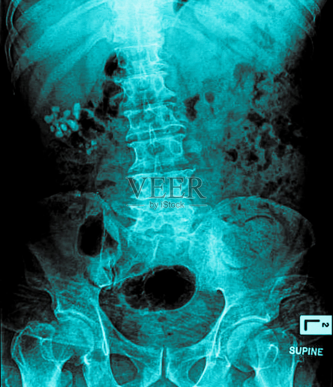 用X光检查肾结石照片摄影图片