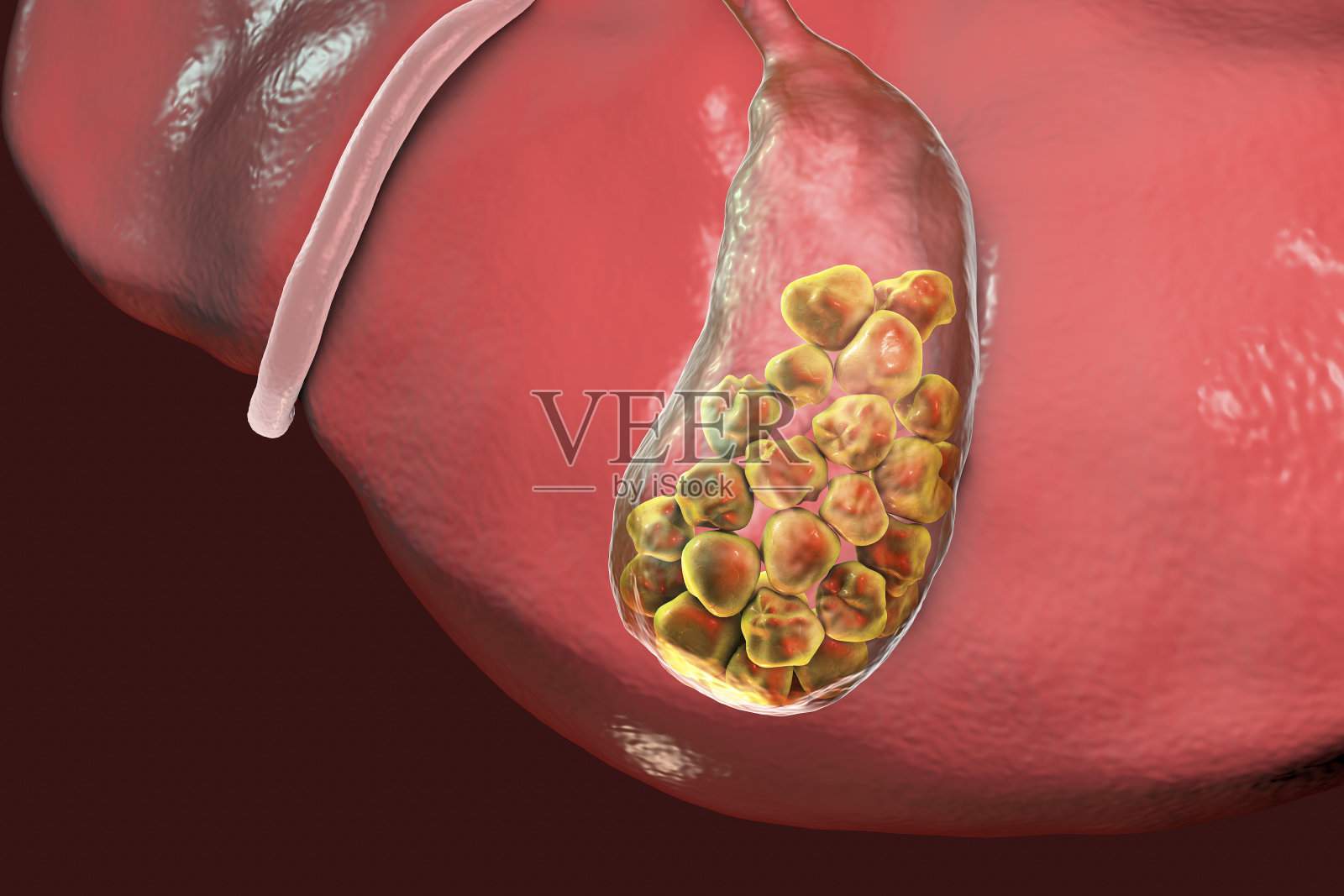 胆结石，图示为伴有结石的肝脏和胆囊的下视图照片摄影图片