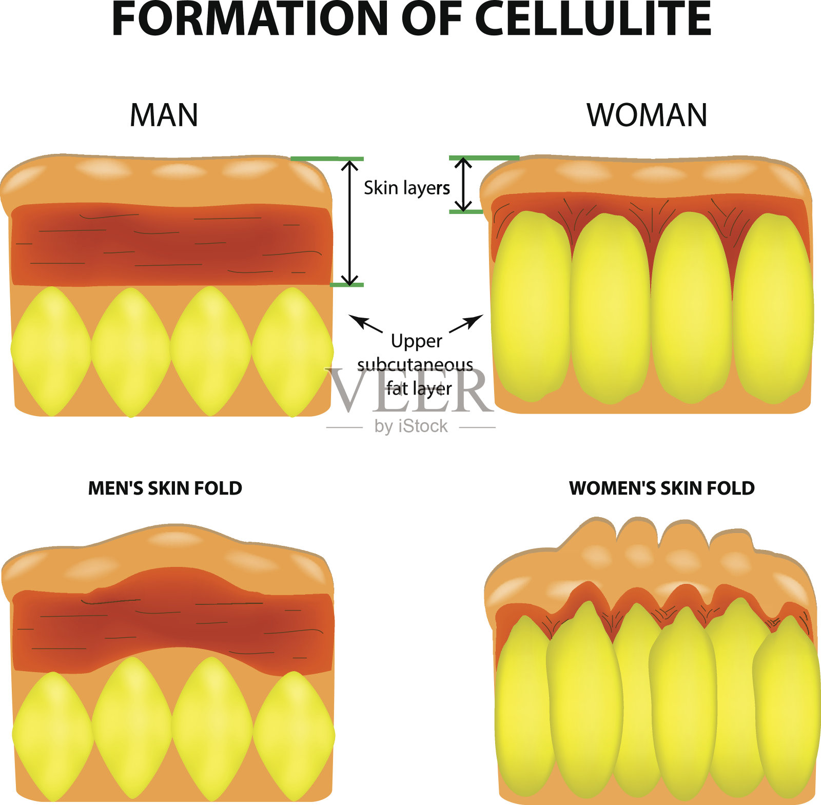 蜂窝织炎和男女皮肤老化。信息图。矢量插图在孤立的背景插画图片素材