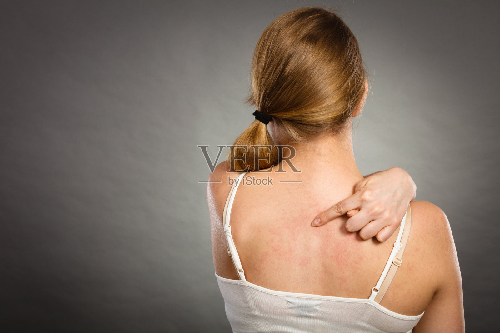 一个女人用过敏皮疹挠着她发痒的后背照片摄影图片