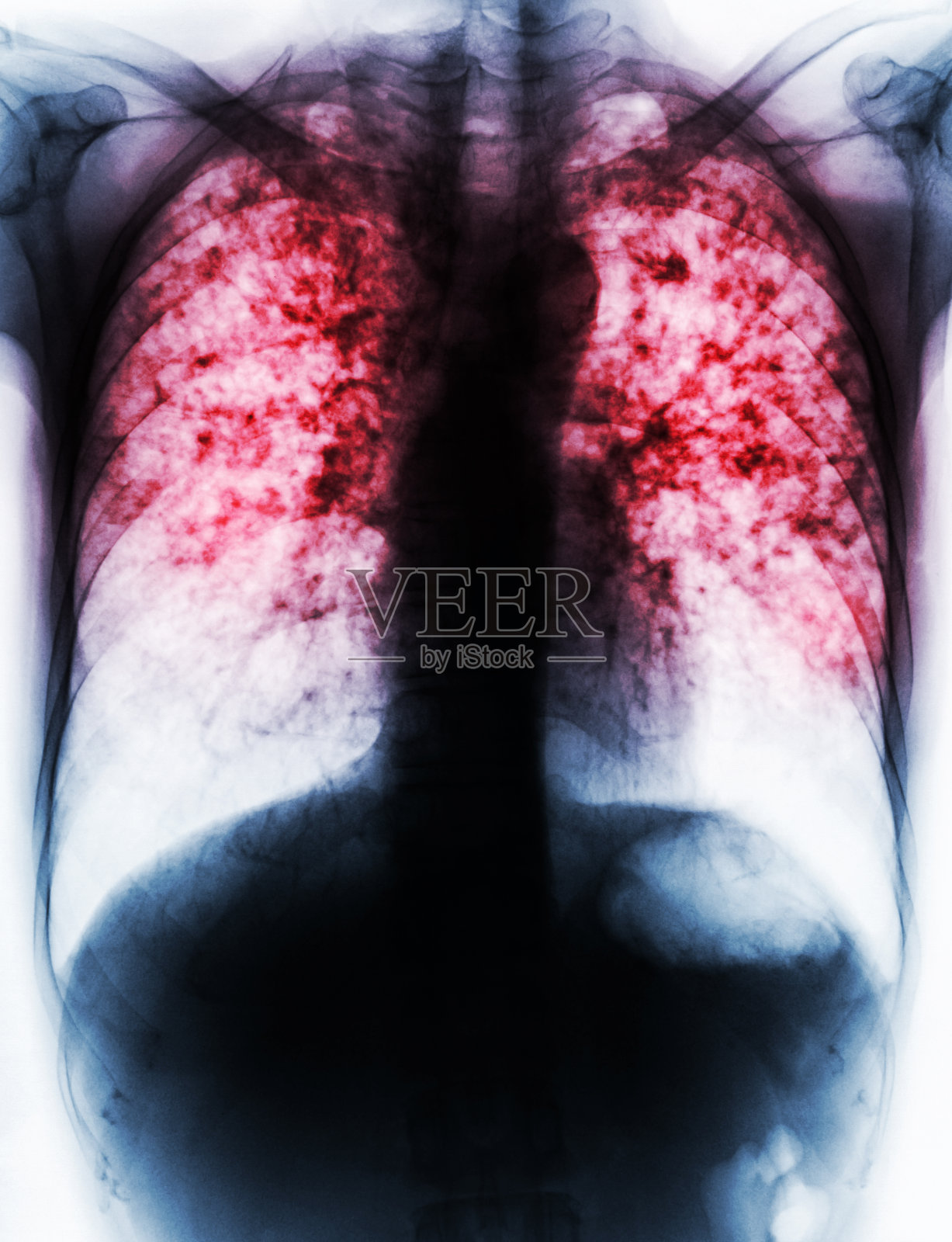 肺结核。照片摄影图片