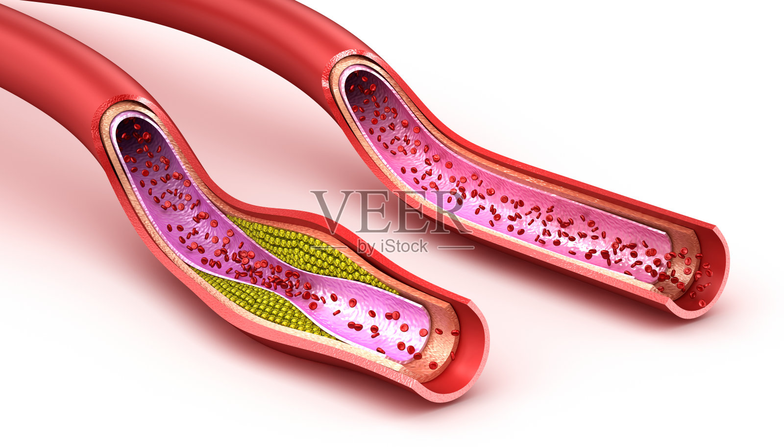血管:正常和胆固醇受损的血管。三维渲染照片摄影图片