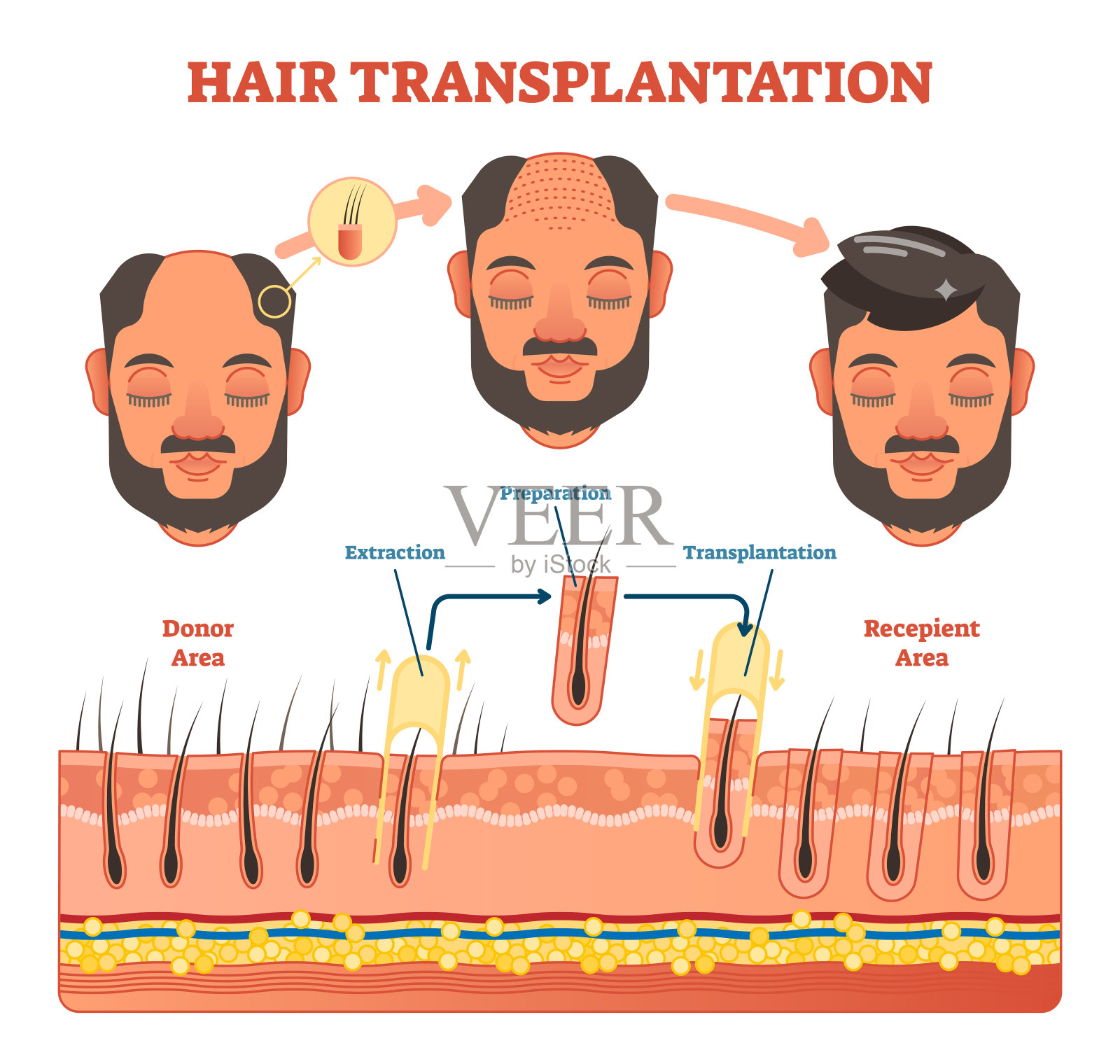 毛发移植手术示意图及步骤插画图片素材