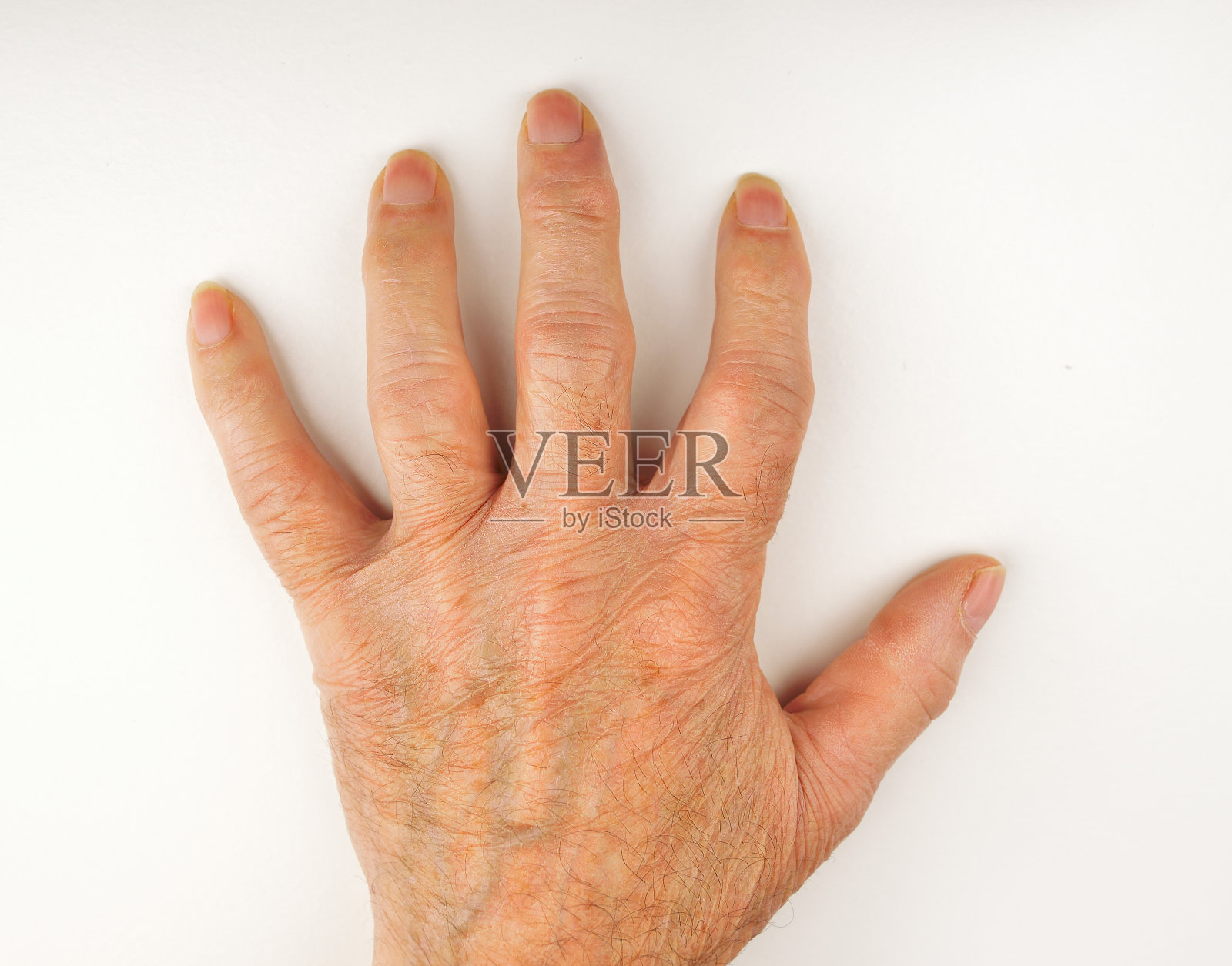 类风湿关节炎导致的手畸形照片摄影图片