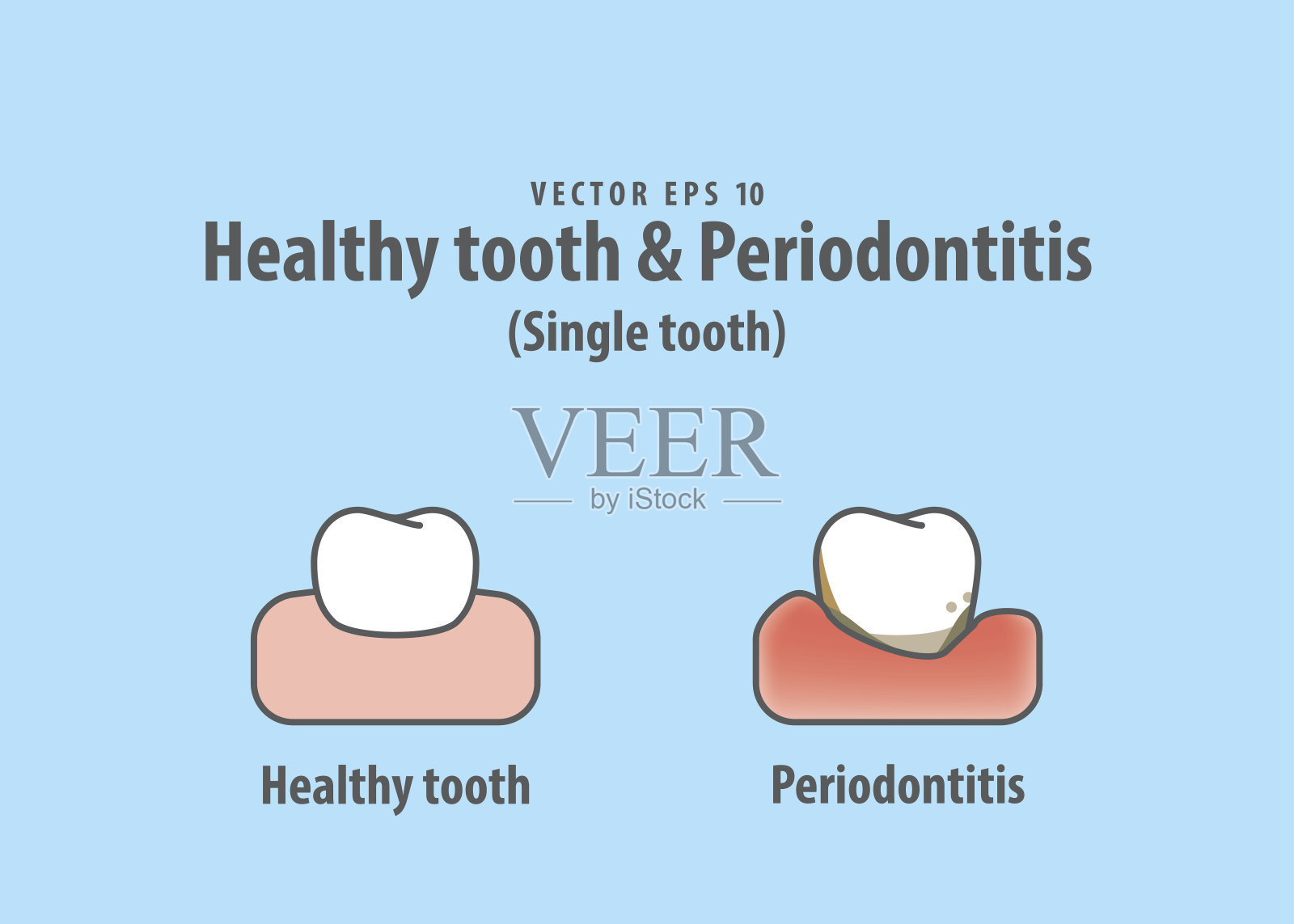 健康的牙齿和牙周炎(单牙)插图矢量在蓝色的背景。牙科的概念。插画图片素材