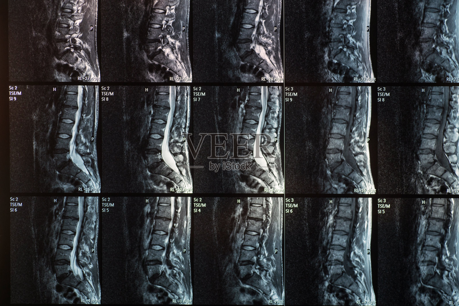 人类脊柱椎间盘突出和脊椎滑脱的磁共振照片摄影图片