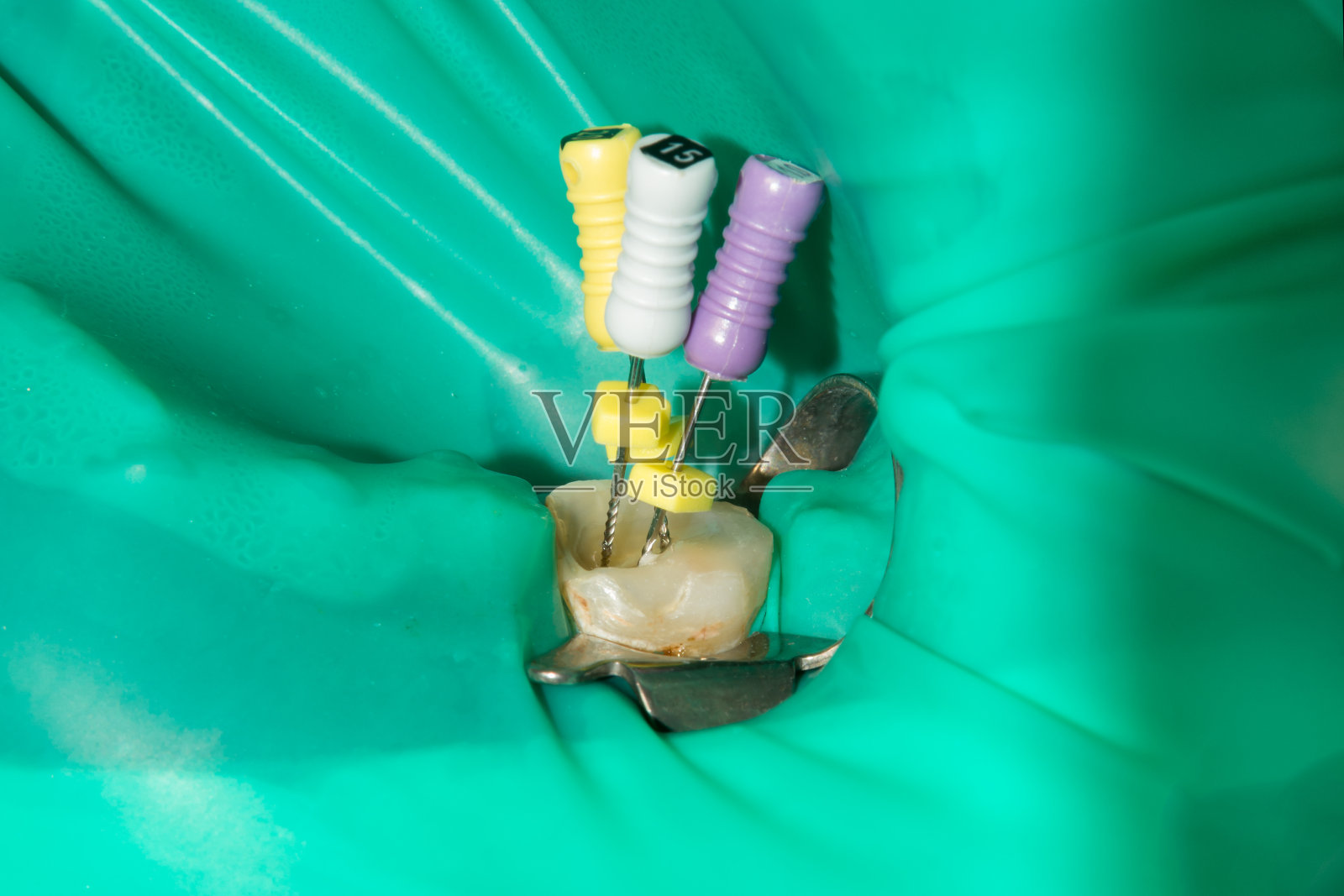 用带根尖定位仪的根管锉治疗下磨牙恒磨牙的根管照片摄影图片