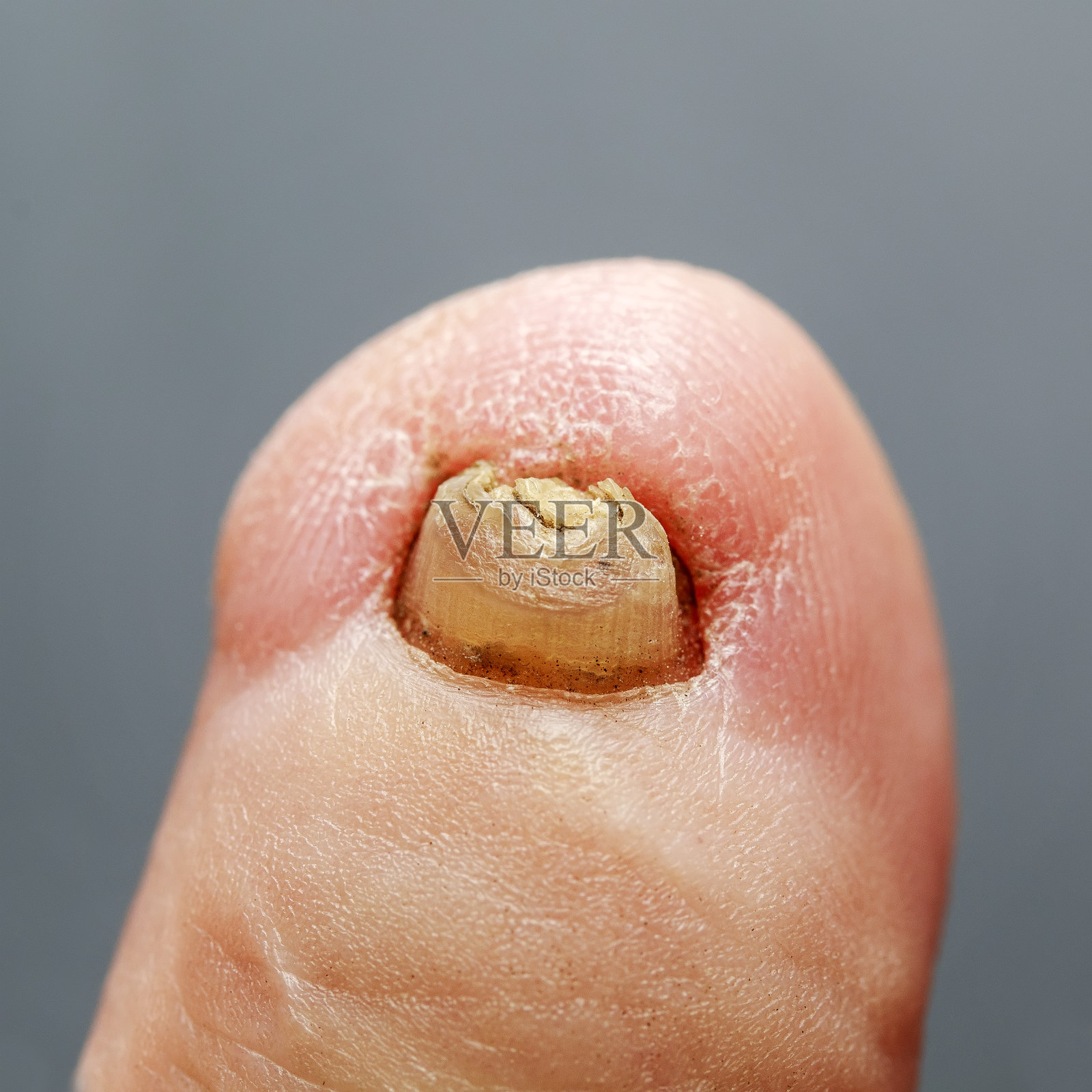 普通的脚趾和一个可怕的指甲受真菌影响照片摄影图片