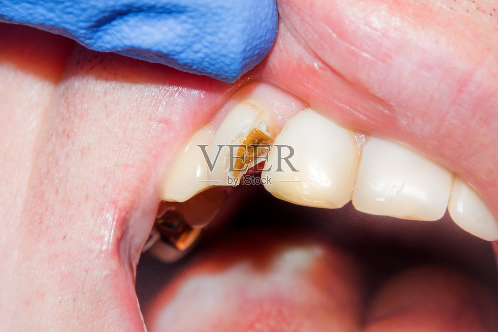 龋齿。用激光充填复合光聚合物材料。牙科诊所牙科治疗的概念照片摄影图片