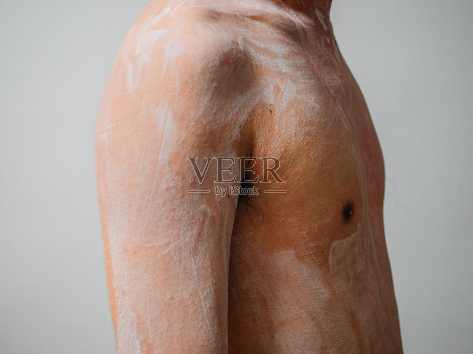 男人身上长疹子的病态皮肤照片摄影图片