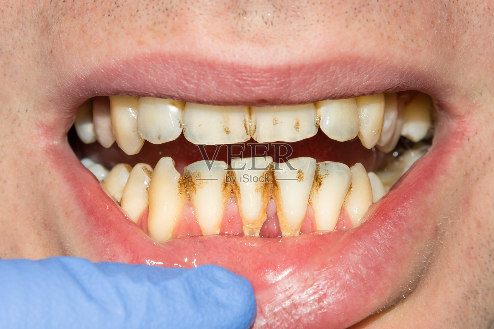 亞洲人常見的虎牙也是一種咬合不正，介紹成因與治療方式 - 淳矯正