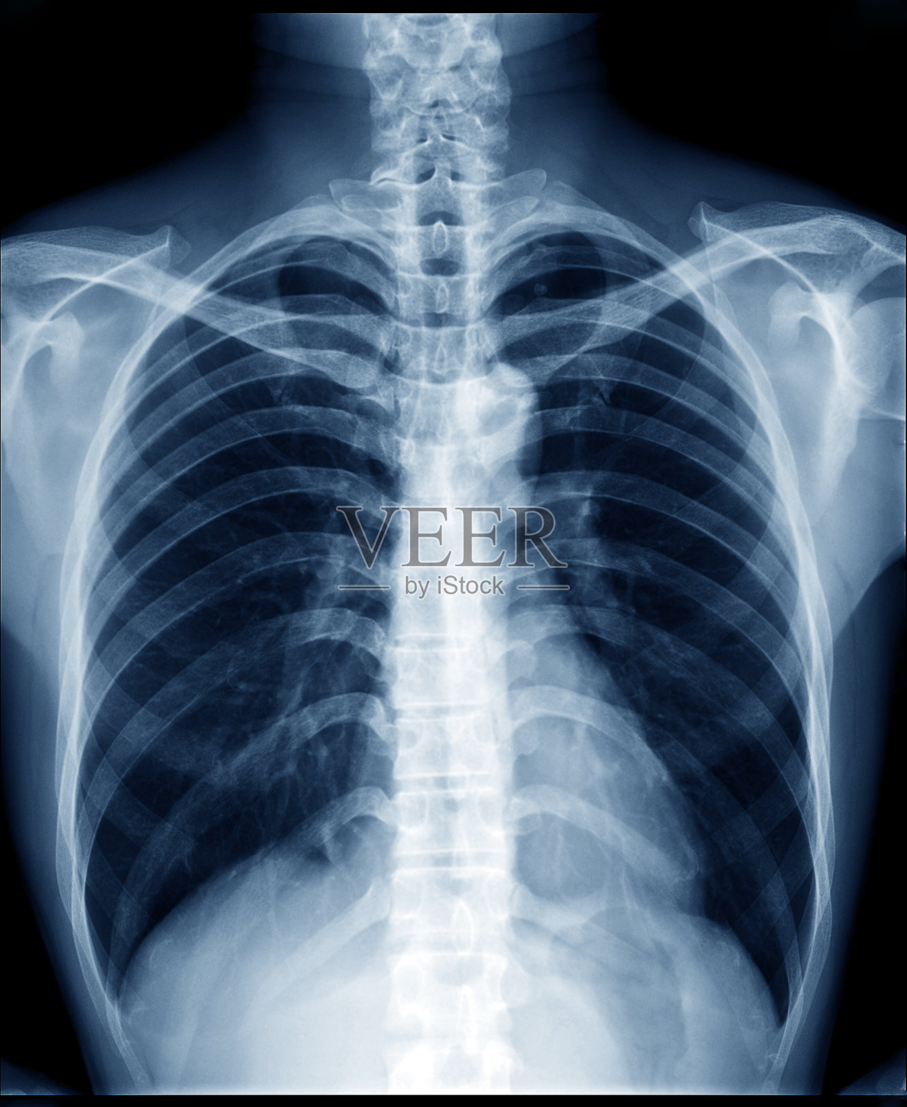 正常健康人的胸部x光片显示肺，心脏，脊柱，锁骨，隔膜照片摄影图片