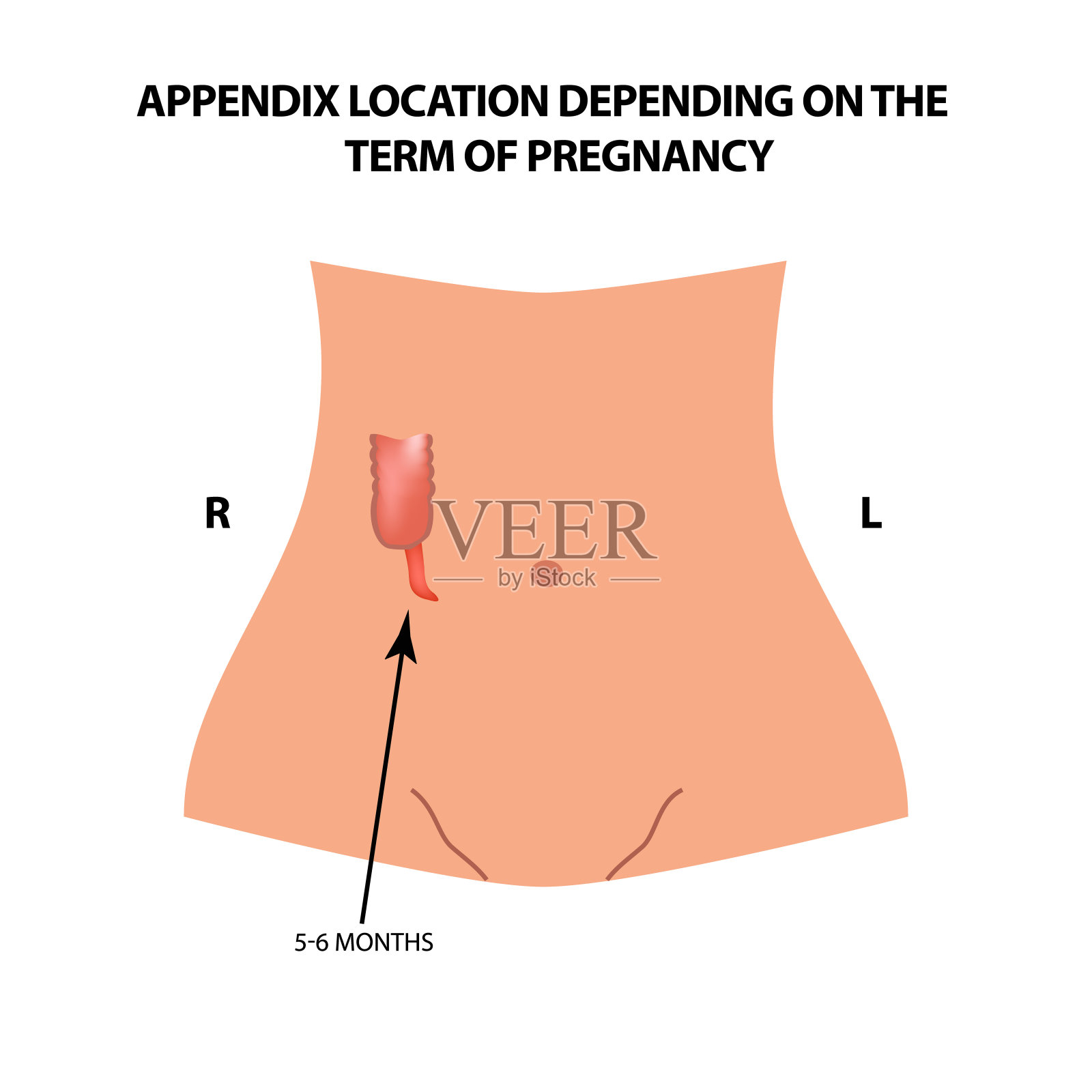阑尾的位置取决于妊娠期。5 - 6个月。信息图。矢量插图在孤立的背景。插画图片素材