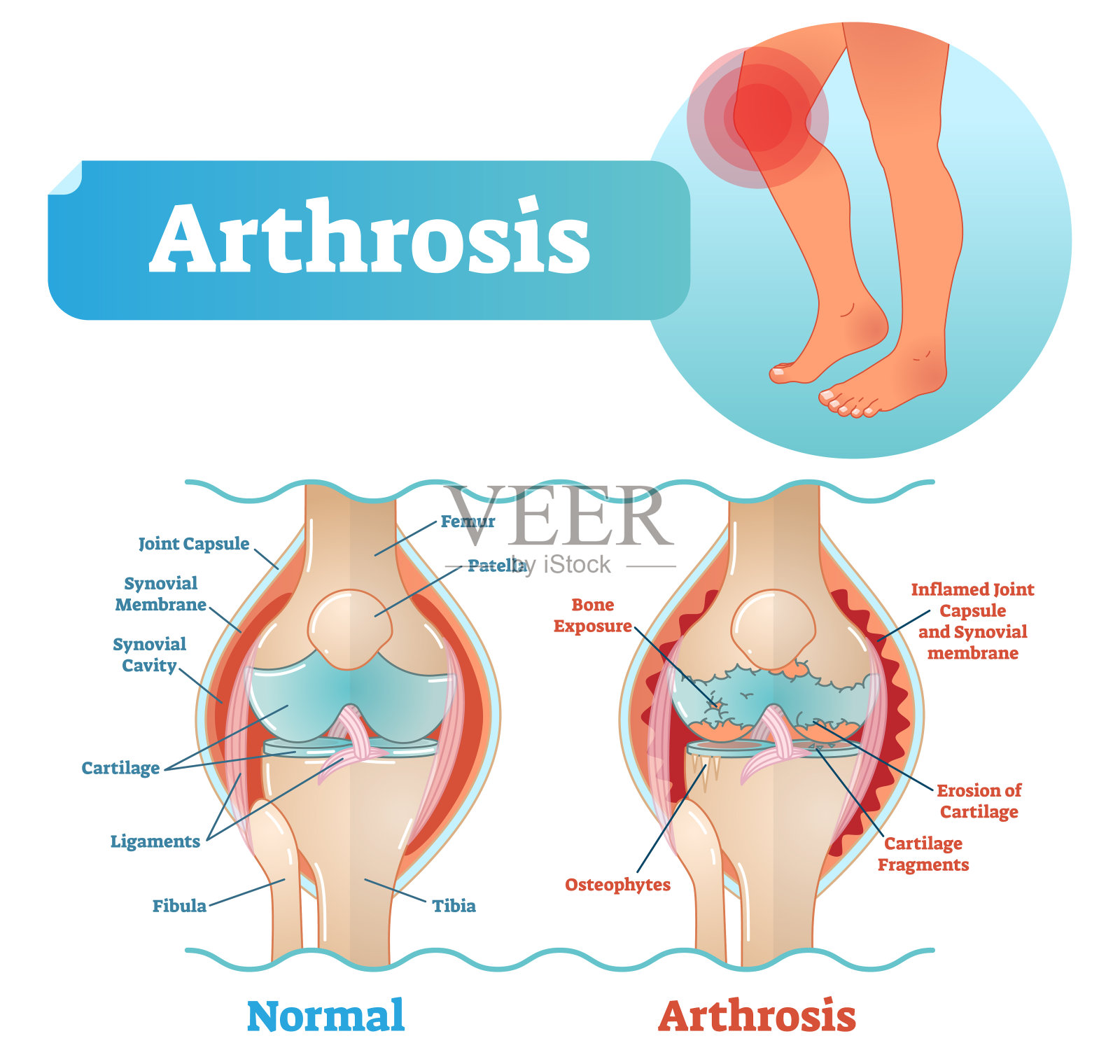 关节病医学载体图解与损伤膝关节结构和健康膝关节比较。插画图片素材