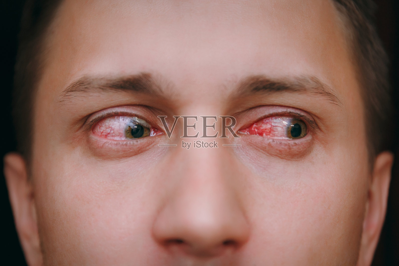一个受结膜炎影响的人的两个烦恼的红色的眼睛的近距离观察照片摄影图片