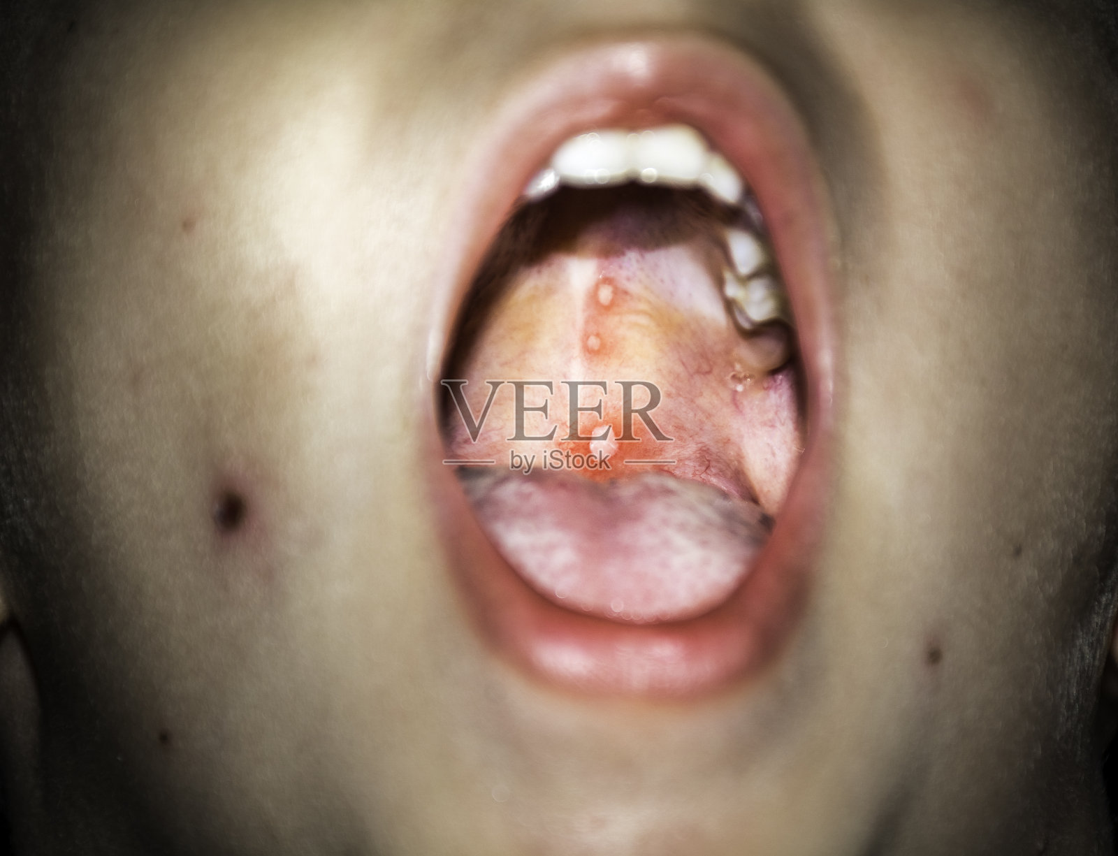 近距离拍摄水痘病毒或水痘水泡疹和丘疹在儿童嘴里的软腭皮肤病学概念