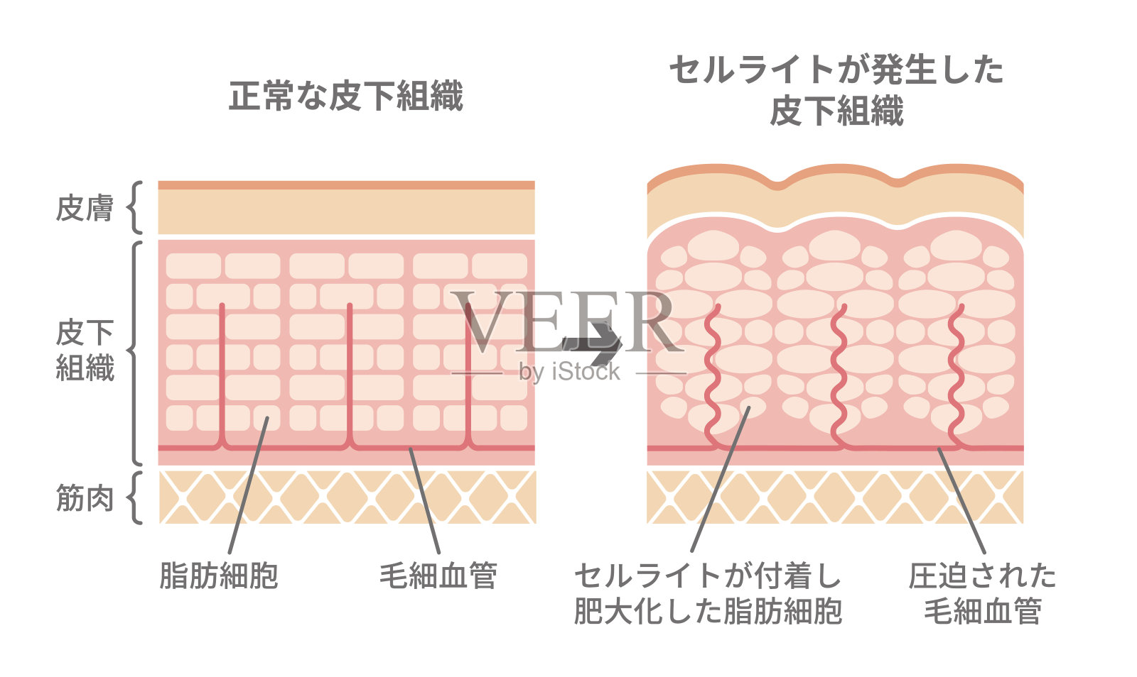 正常皮肤与脂肪团皮肤对比图(日语)插画图片素材