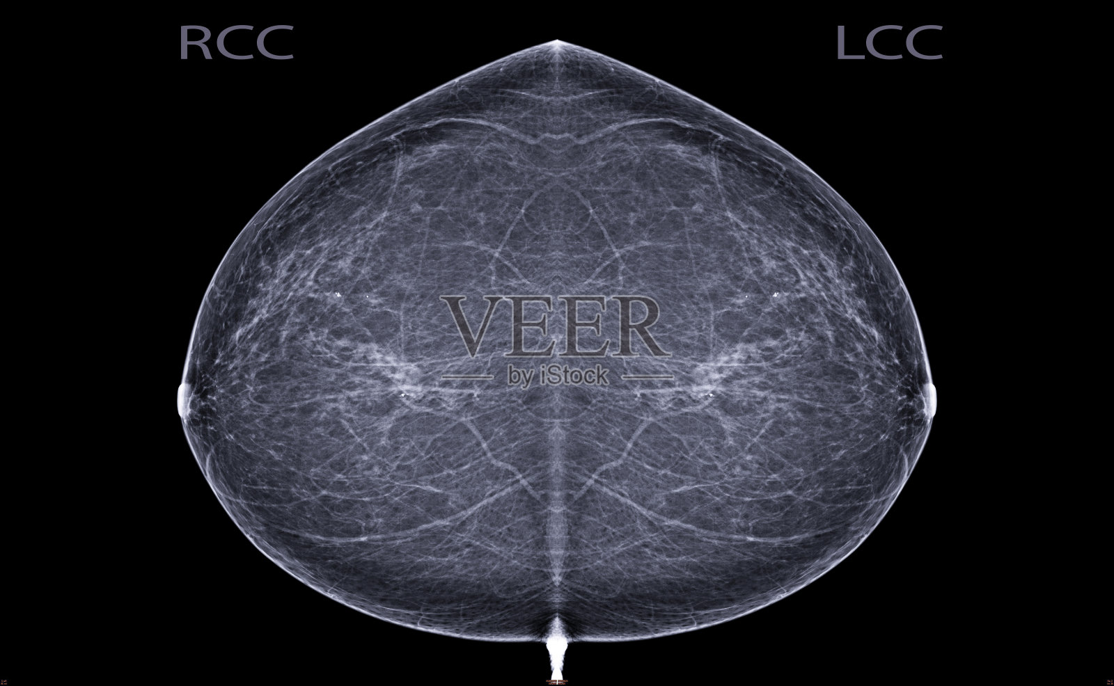 x射线数字乳房x光或乳房x光检查双侧乳腺CC视图，以发现女性乳腺癌。照片摄影图片