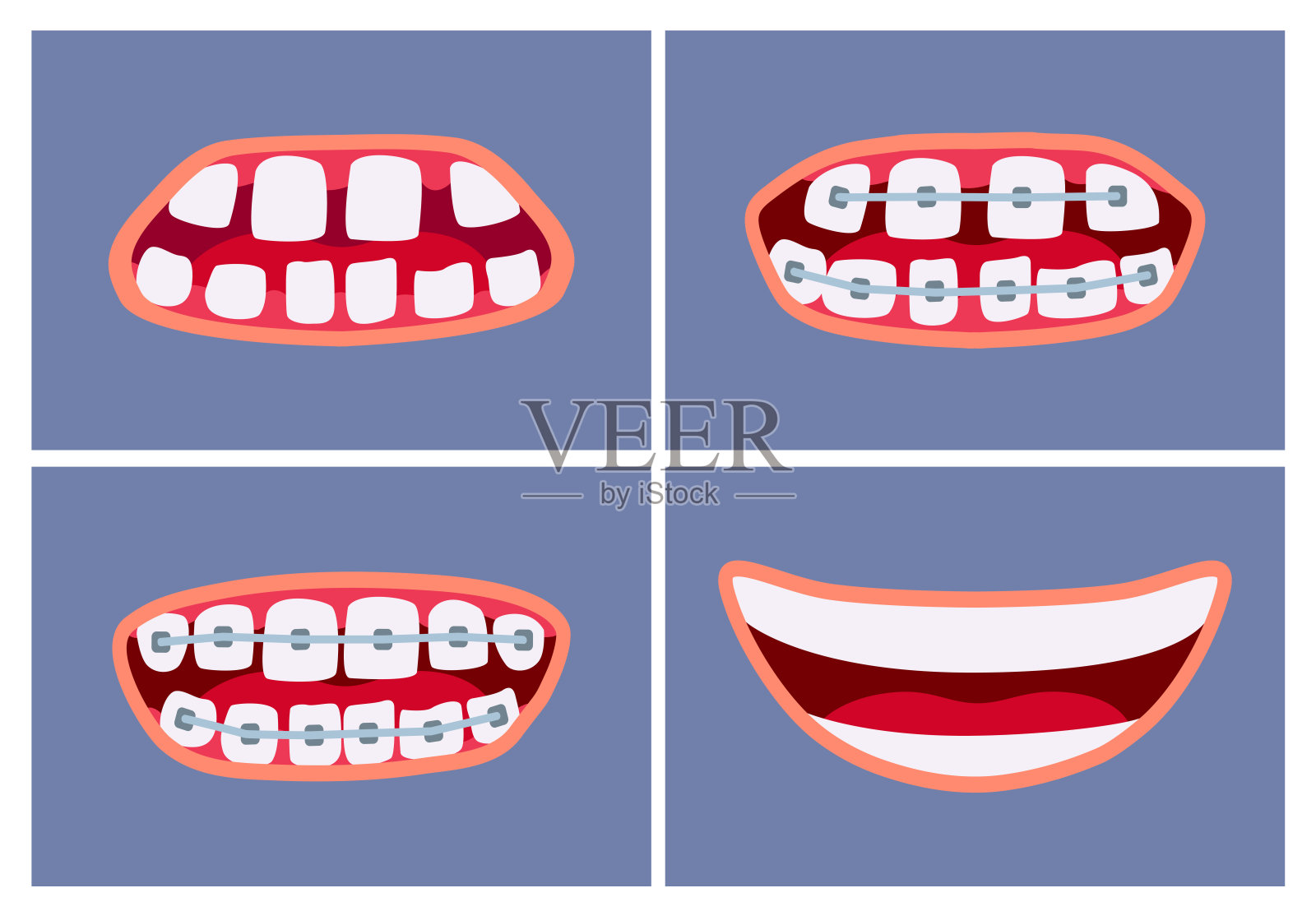 使用牙套前后的口腔。牙齿矫正治疗。插画图片素材