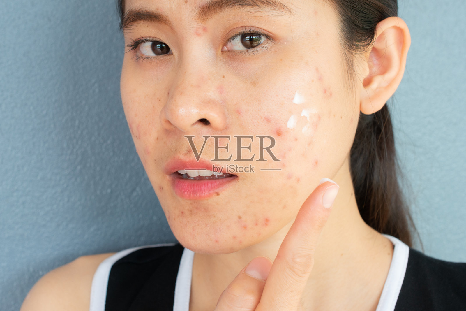女人的肖像痤疮炎症(丘疹和脓疱)在她的脸上，她在她的脸上涂抹痤疮霜治疗。照片摄影图片