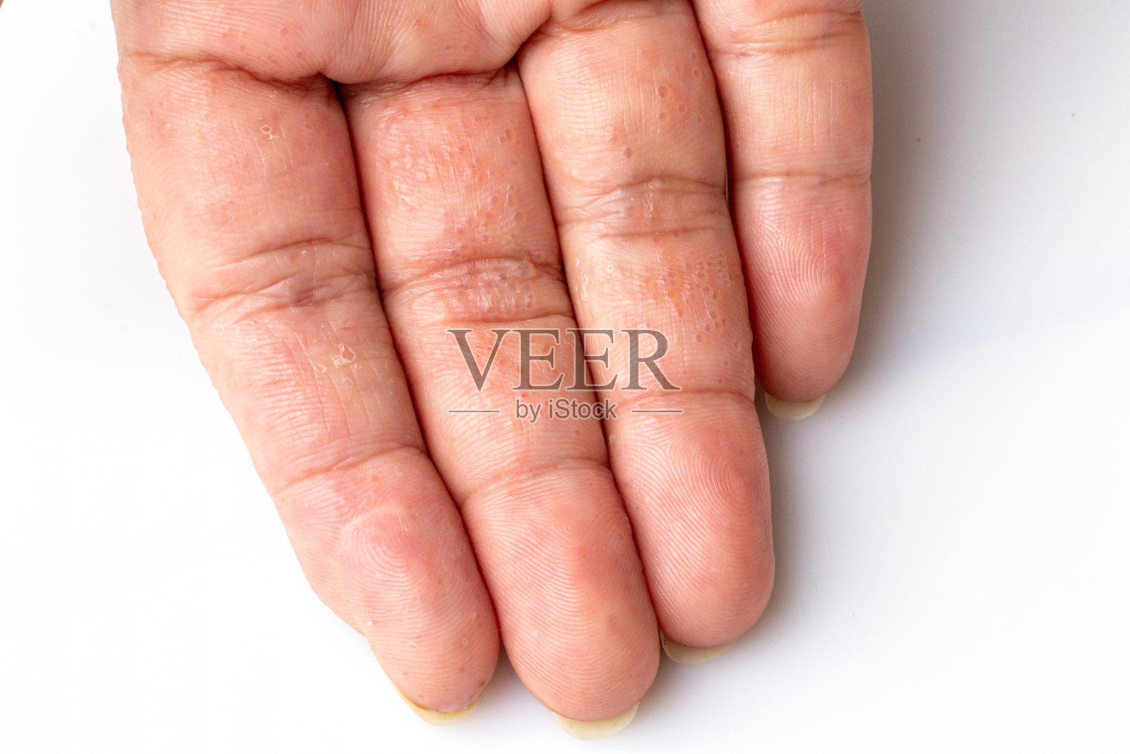 手指特应性皮炎(AD)，又称特应性湿疹。皮肤病的概念。照片摄影图片