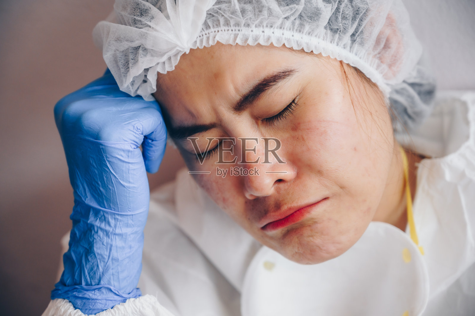 covid-19大流行期间，医护人员在医院工作后长时间佩戴医用口罩，脸上有伤口和痤疮，压力很大。照片摄影图片
