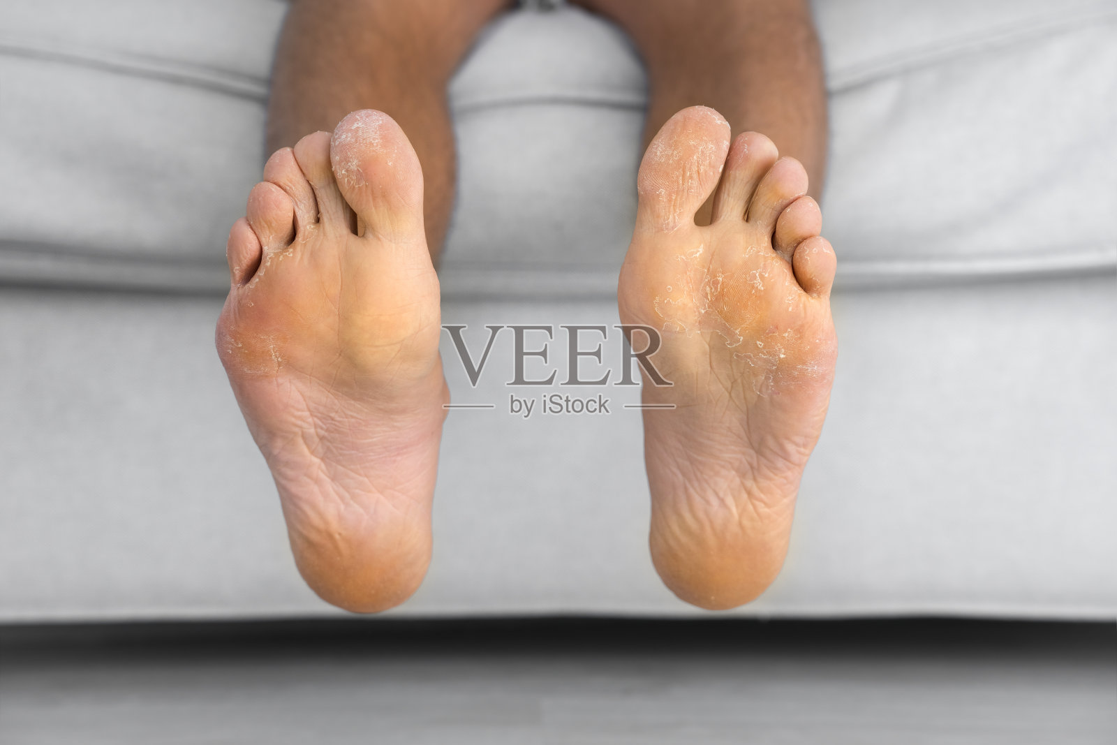 一名男子露出他龟裂的脚。真菌感染或足癣，皮肤干燥，皮炎，湿疹，牛皮癣，出汗或脱水。卫生保健的概念照片摄影图片