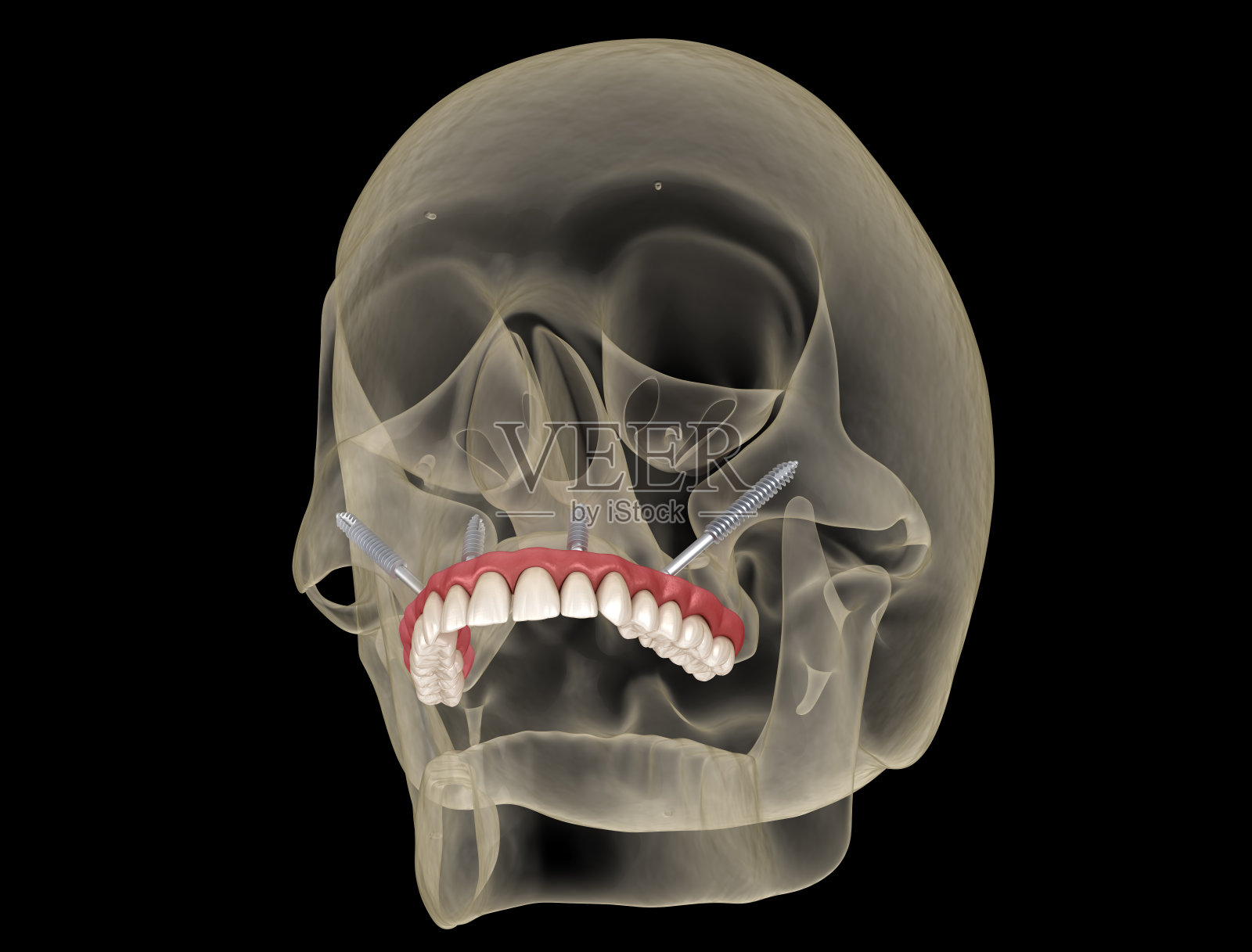 上颌假体由颧骨植入物支撑。医学上准确的人类牙齿和假牙的3D插图照片摄影图片
